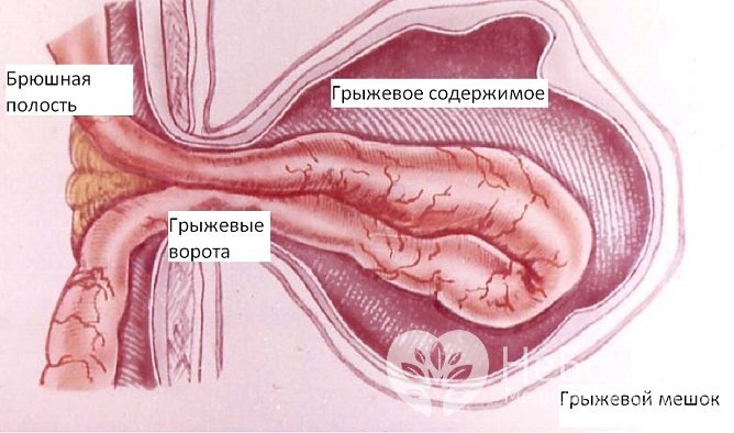 При ущемлении пупочной грыжи возникает резкая боль, кишечная непроходимость, тошнота и рвота