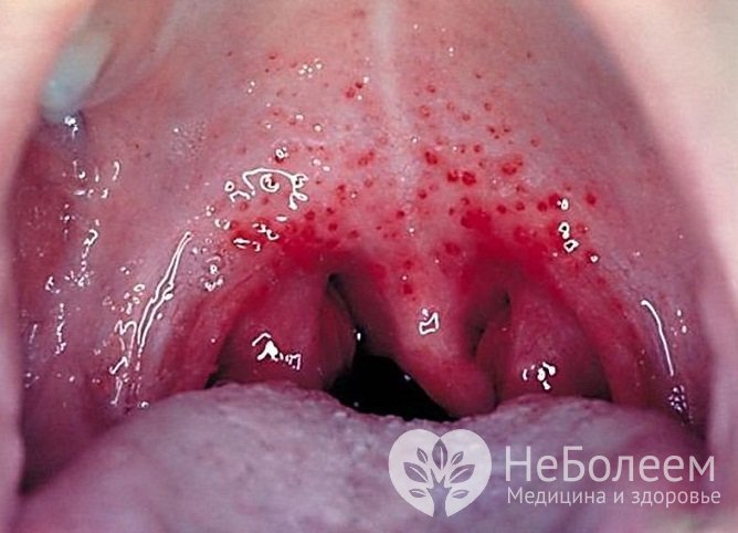 У детей 3-10 лет вирус Коксаки нередко провоцирует развитие герпетической ангины
