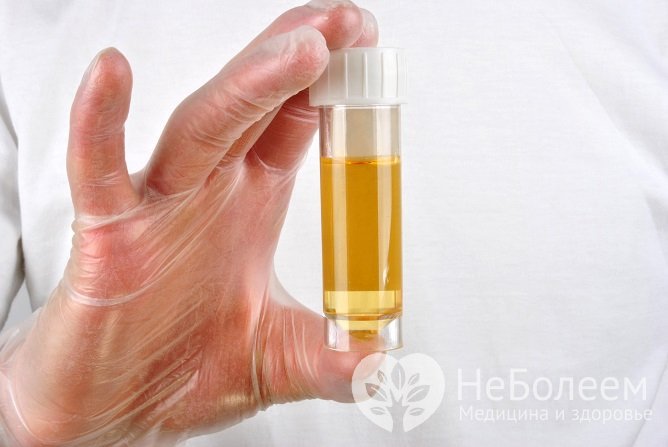 Анализ по Нечипоренко – это изучение осадка мочи, образовавшегося при ее центрифугировании