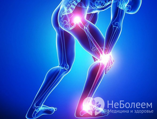 Ревматизм может возникать как осложнение ангины