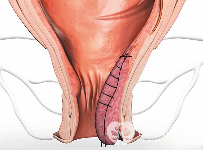 Метод HAL RAR обеспечивает полное излечение геморроя в 90% случаев