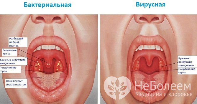 При осмотре выявляются признаки воспалительного процесса в слизистой оболочке глотки бактериальной или вирусной этиологии