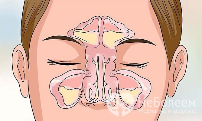 При гнойном синусите может поражаться одна или несколько околоносовых пазух