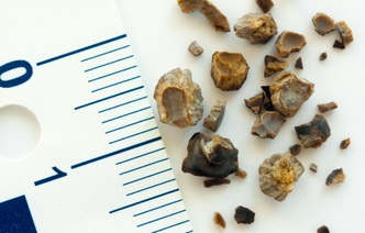 Камни в организме: 4 места, о которых не все знают