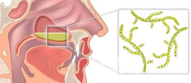 Применение препаратов с противогрибковым действием показано при микотических поражениях пазух носа