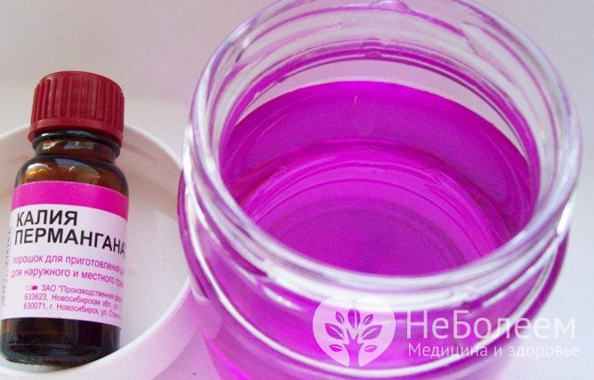 Сидячие ванночки с раствором марганцовки помогают при обострении геморроя