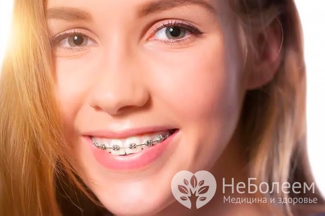 Можно ли ставить брекеты при проблемах с деснами