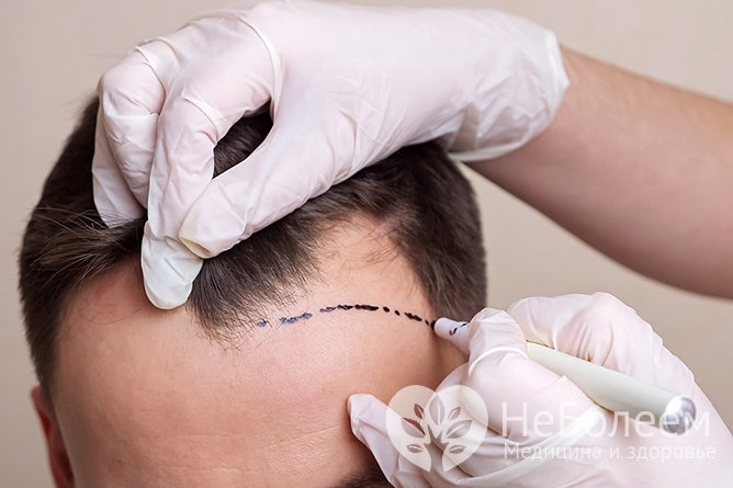 Пересадка волос: современный путь к восстановлению густоты