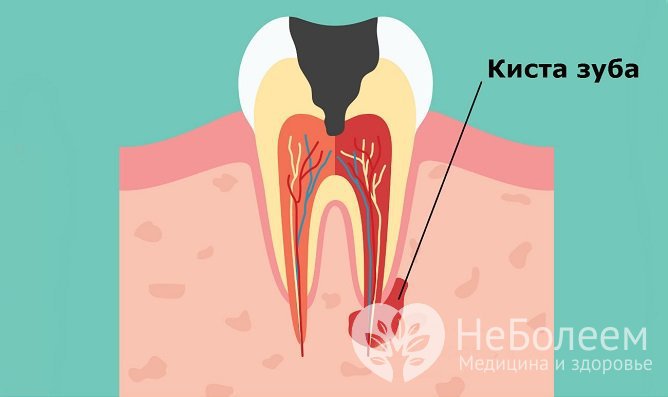 Прикорневая киста зуба развивается вследствие распространения инфекции на окружающие корень ткани
