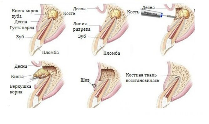 Хирургическое удаление - наиболее эффективный метод лечения зубной кисты