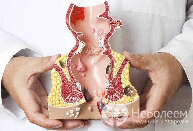 Факторы риска развития геморроя